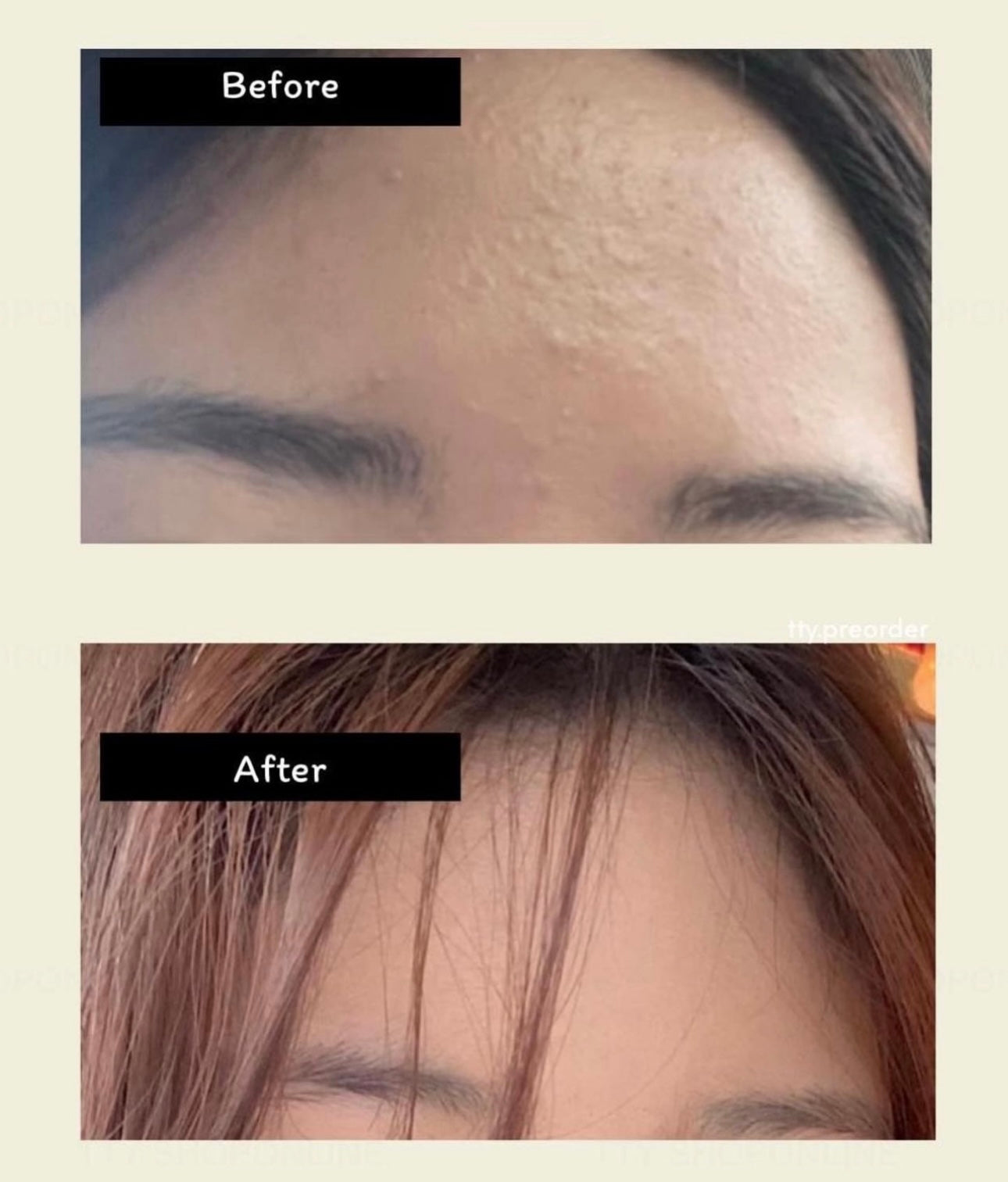 化解排行榜第一位 🌟Torriden 5D低分子透明質酸保濕爽膚水300ml+300ml💧