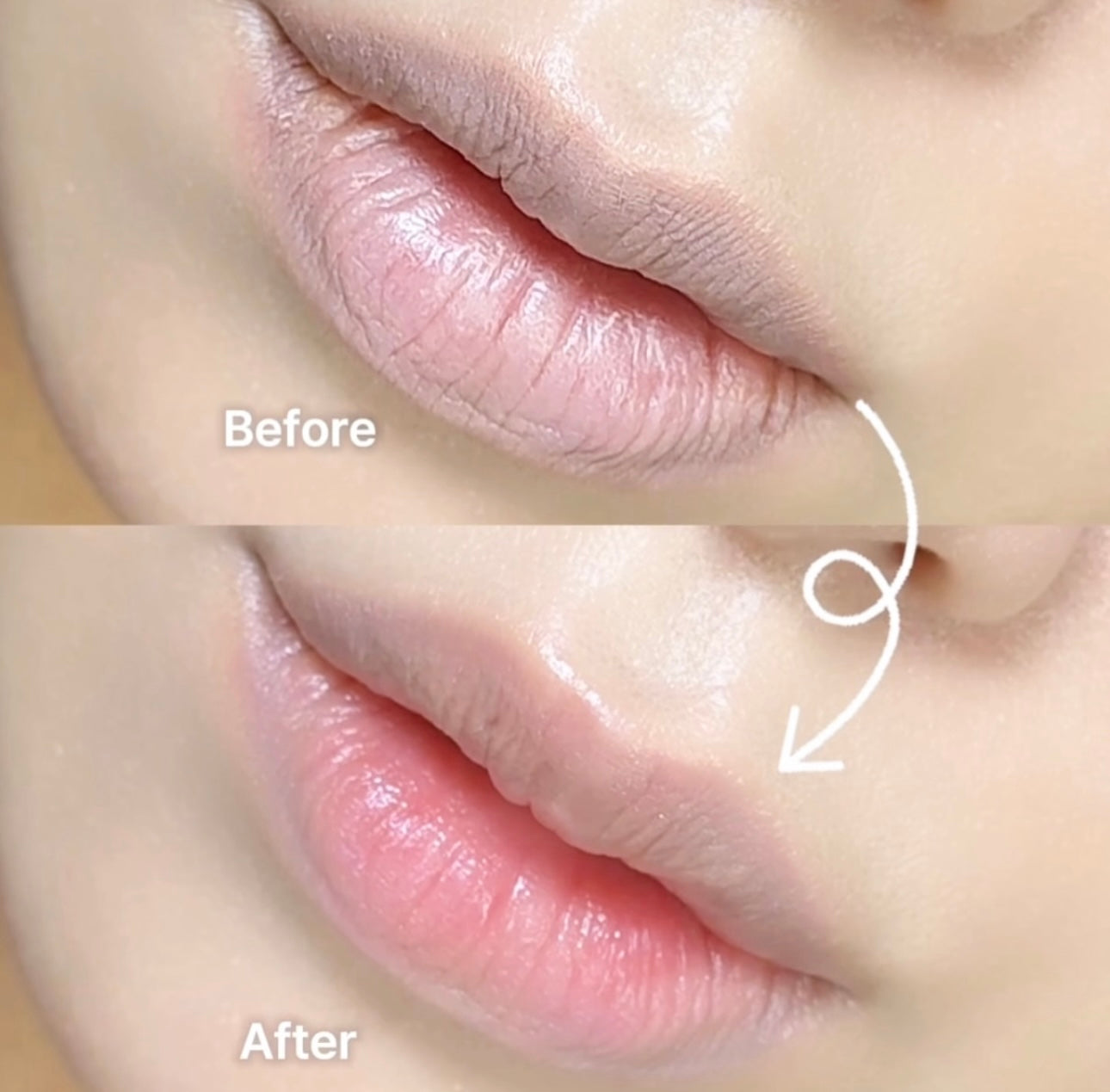 ANUA PDRN透明質酸水潤唇部精華🩵| 乾燥唇救星來啦💦ANUA PDRN LIP SERUM