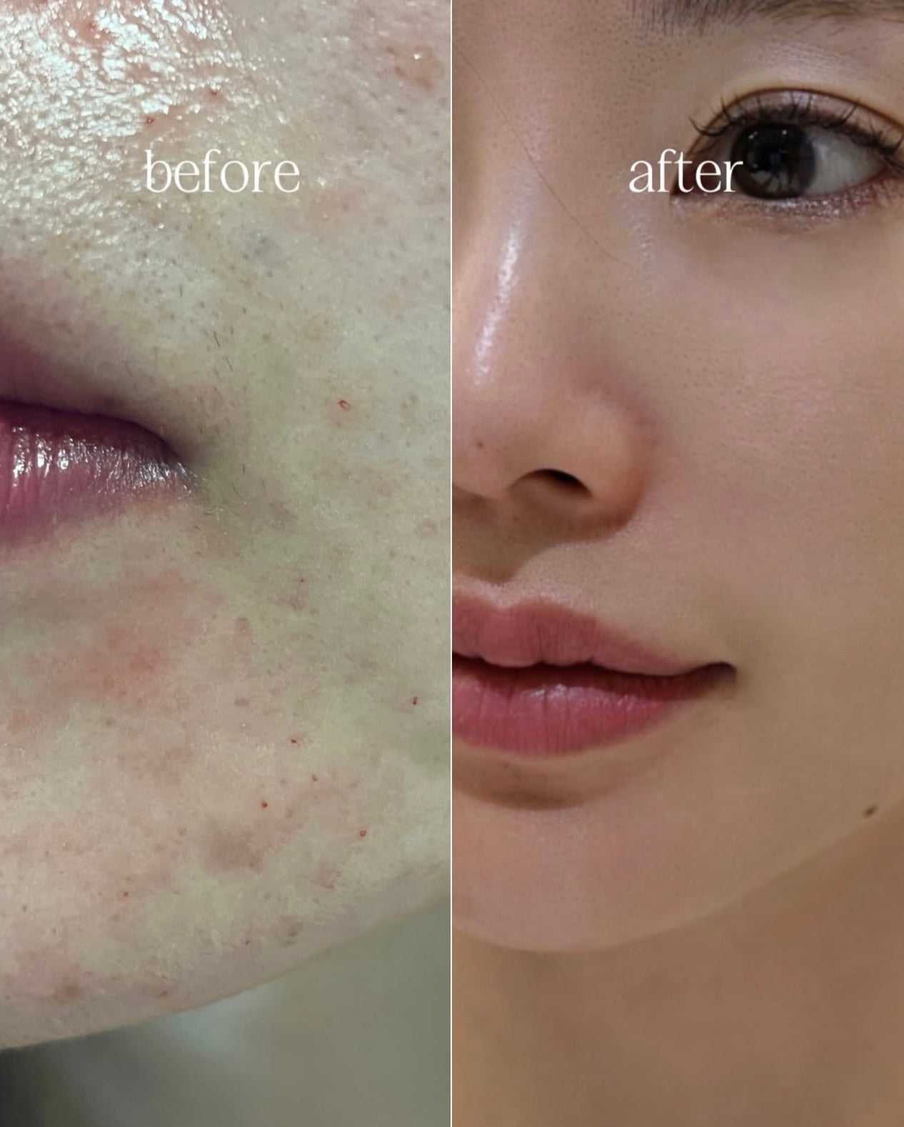 韓國藥房款🏥Rejuall 麗珠蘭高濃度PDRN底層修復再生霜⭐️|  Rejuall Advanced PDRN Relief Cream