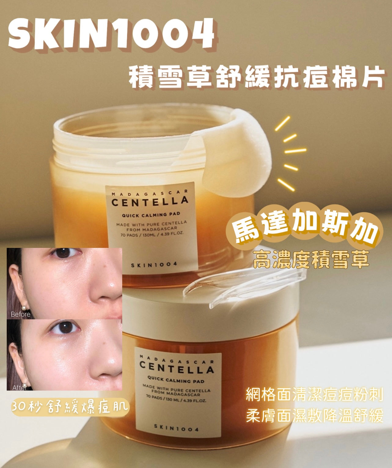 30秒舒緩爆痘肌✨| 韓國熱銷百萬片SKIN1004 馬達加斯加積雪草舒緩抗痘棉片☁️| SKIN1004 MADAGASCAR CENTELLA QUICK CALMING PAD