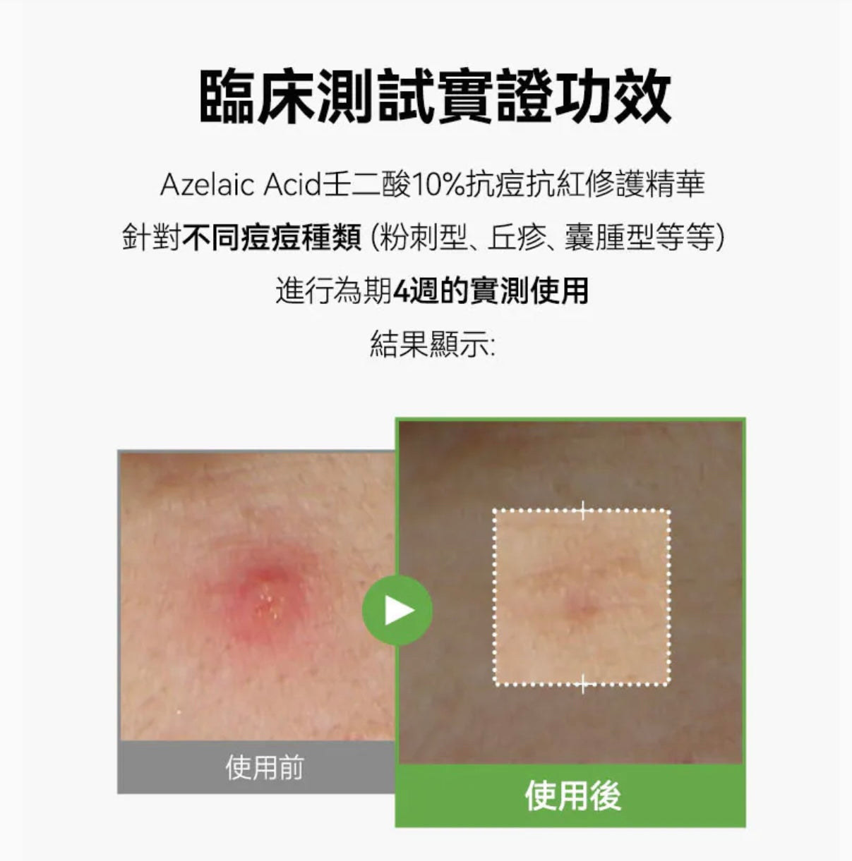 超多客人搵佢🔥告別煩人粉刺、紅疹、痘印⭐️Anua Azelaic壬二酸10%抗痘抗紅修護精華💚 Anua Azelaic Acid 10 Hyaluron Redness Soothing Serum