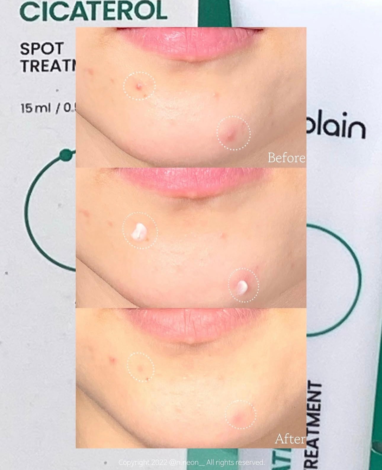 敏感痘痘肌必備✨| Beplain積雪草修復袪痘精華乳霜🌿Beplain Cicaterol Spot Treatment