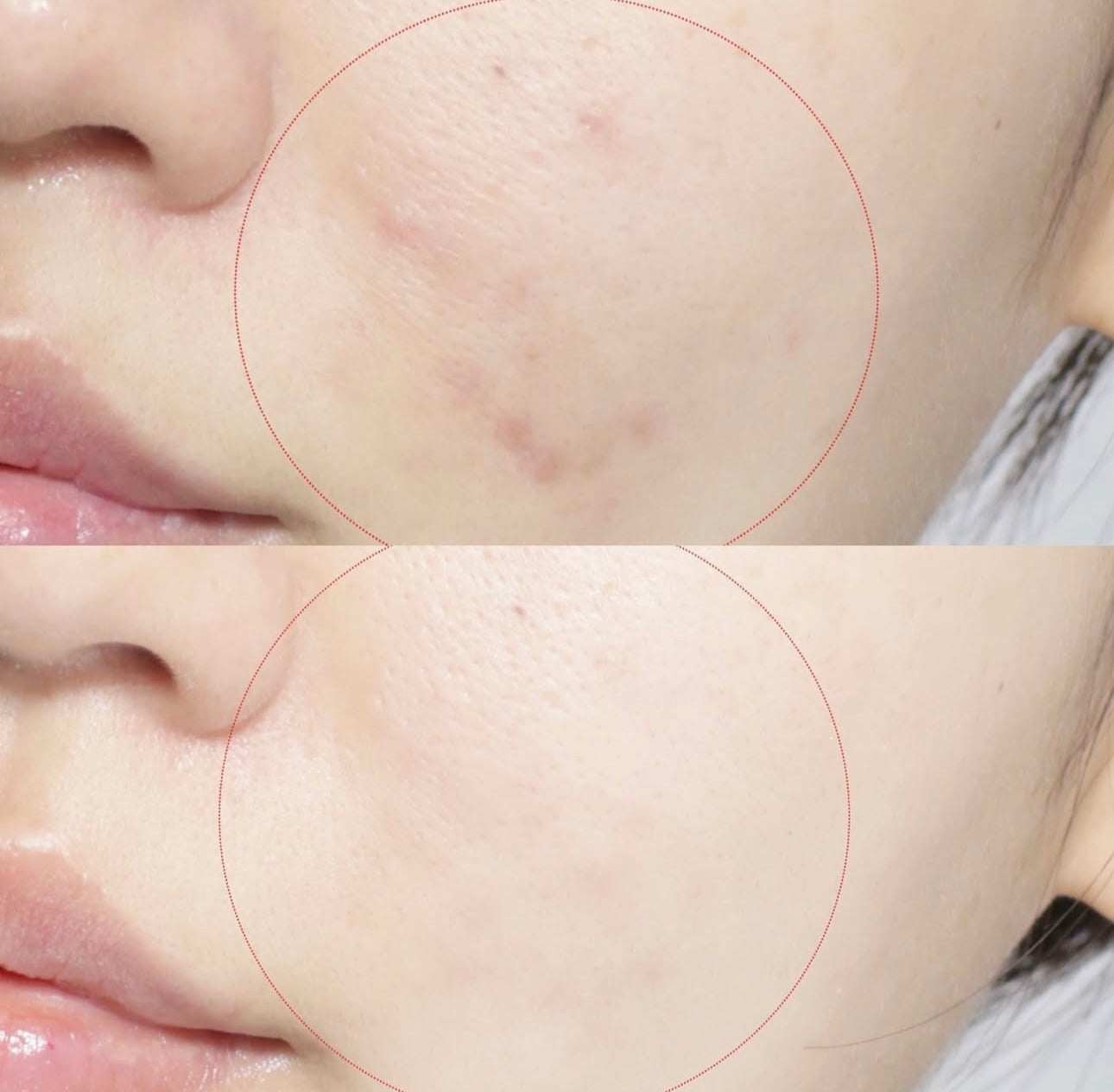 送去痘凝膠精華✨Centellian24 積雪草茶樹舒緩淨痘雙效修護粉