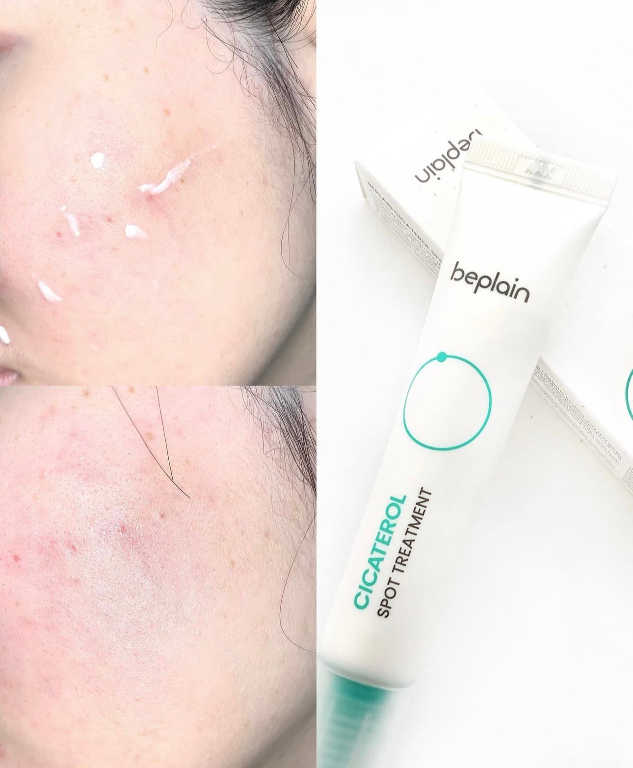 敏感痘痘肌必備✨| Beplain積雪草修復袪痘精華乳霜🌿Beplain Cicaterol Spot Treatment