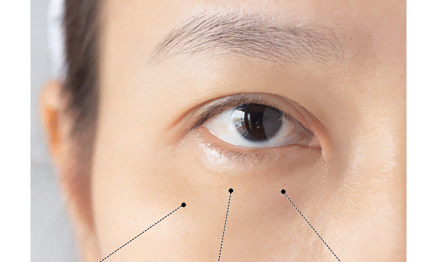 CHARDE 1100 shot 微針玻尿酸眼貼💉💧| 高純度玻尿酸直接灌入肌底🪽