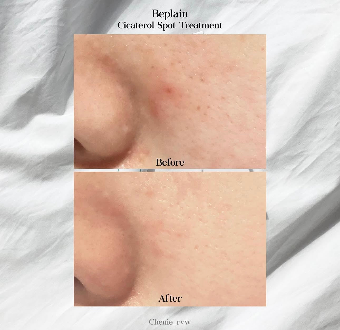 敏感痘痘肌必備✨| Beplain積雪草修復袪痘精華乳霜🌿Beplain Cicaterol Spot Treatment