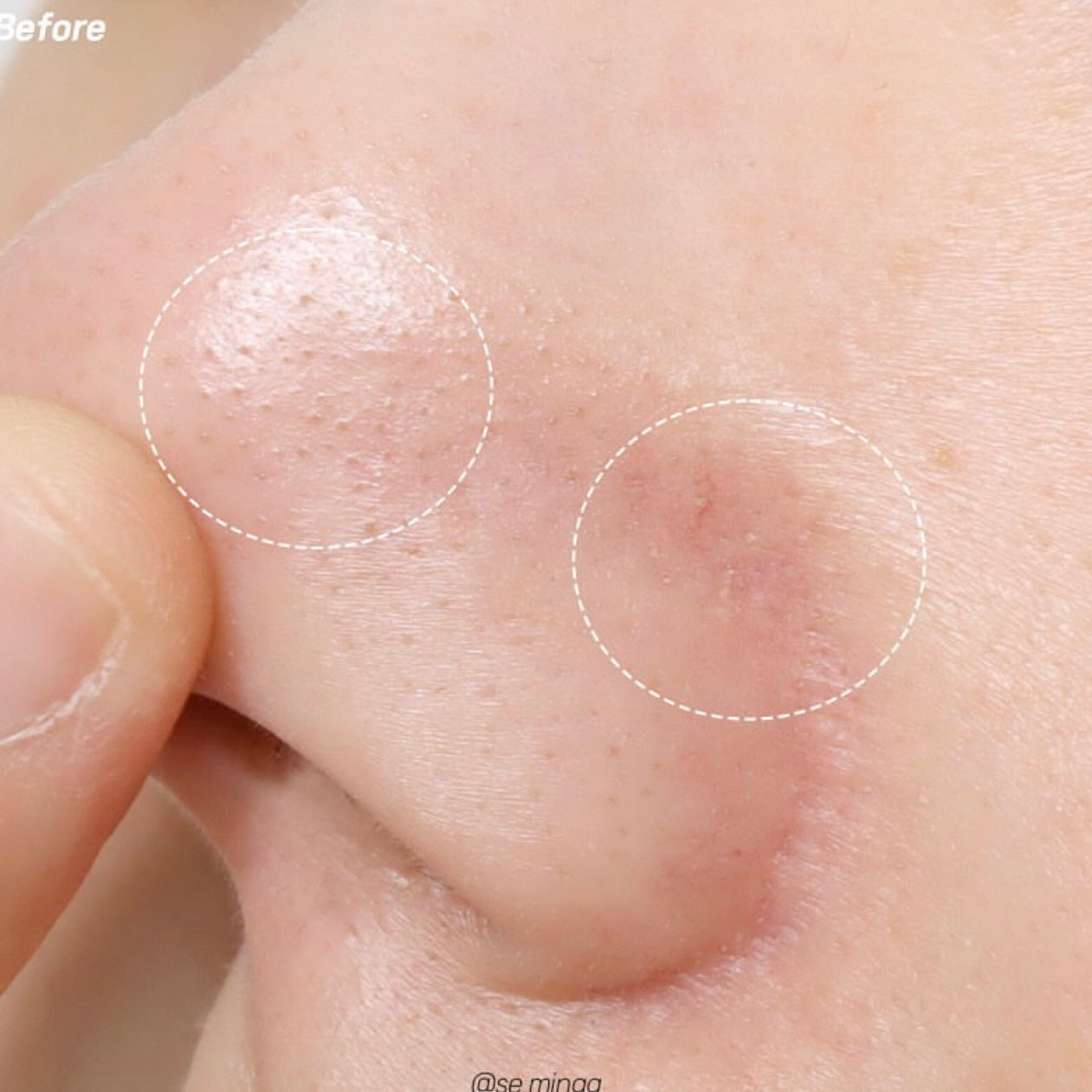 Hello Kitty x Ilso 限量特別版💖黑頭粉刺必試款🧹| Ilso溶解皮脂收毛孔導出液套裝 Ilso Super Melting Sebum Softener🦋