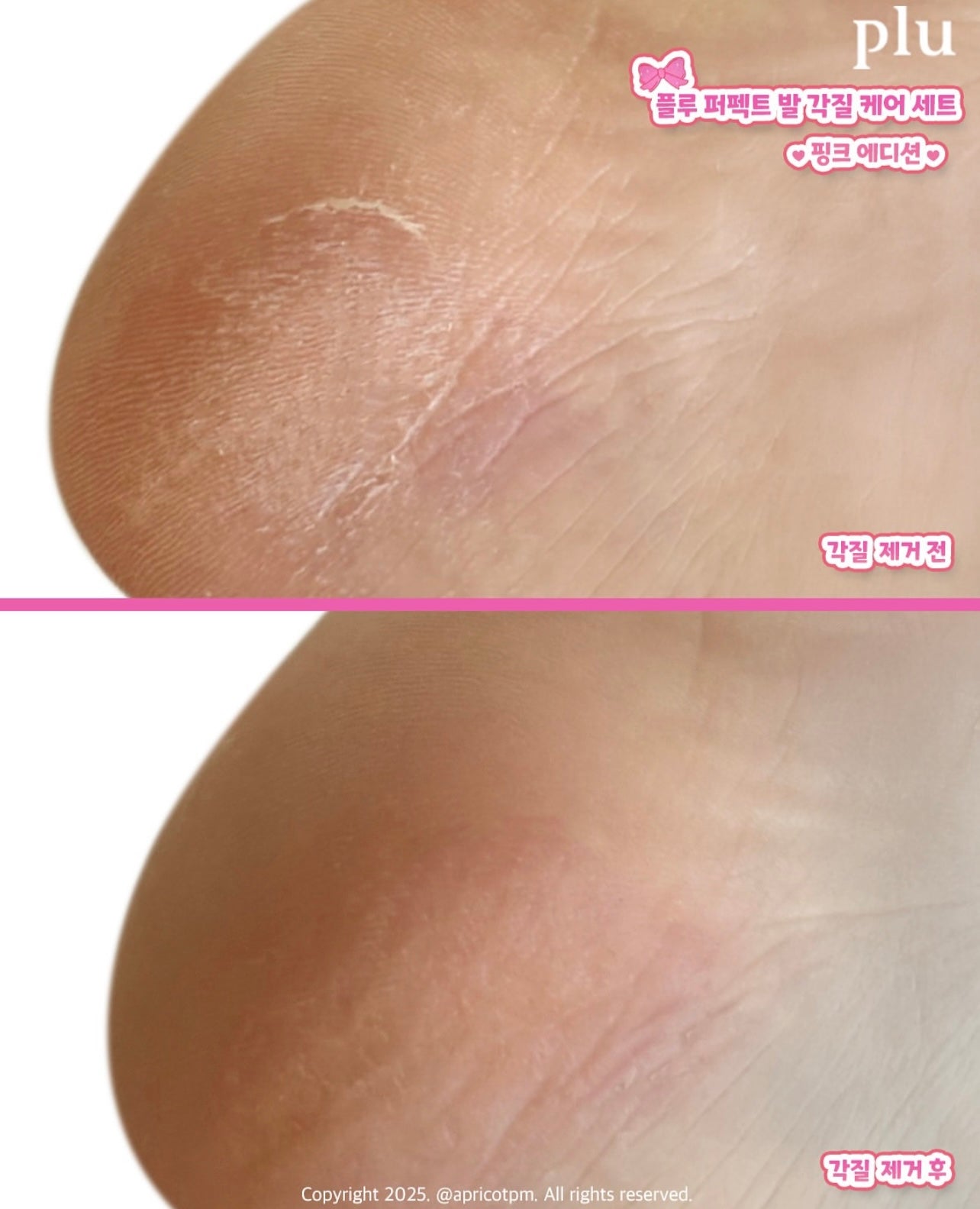 送死皮刮刀✨Plu 強效角蛋白強化修護足霜+完美足部去角質套裝 🦶🏻| PLU Intensive Repair Foot Cream