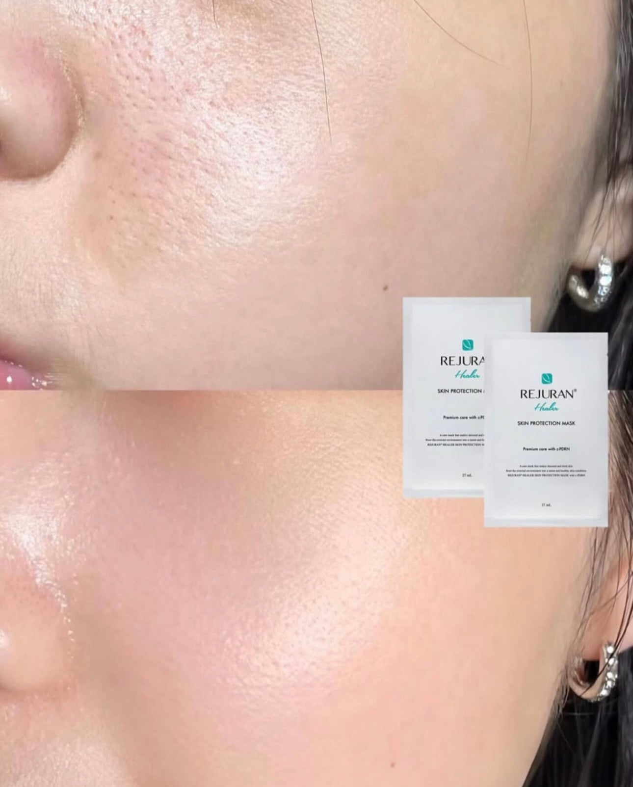 水光針界天花板💉修復乾燥疲憊肌膚✨|Rejuran Skin Protection Mask 麗珠蘭嬰兒水光針修復煥膚面膜👶🏻