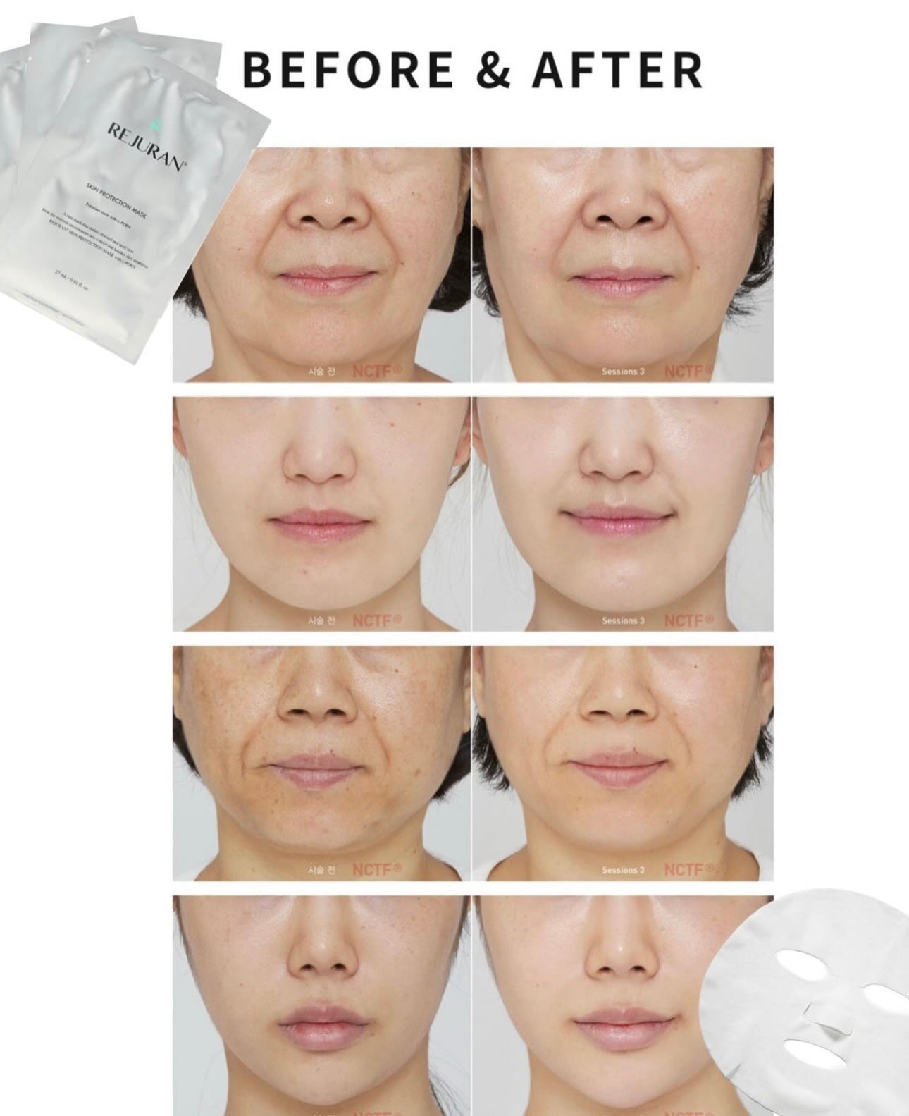 水光針界天花板💉修復乾燥疲憊肌膚✨|Rejuran Skin Protection Mask 麗珠蘭嬰兒水光針修復煥膚面膜👶🏻