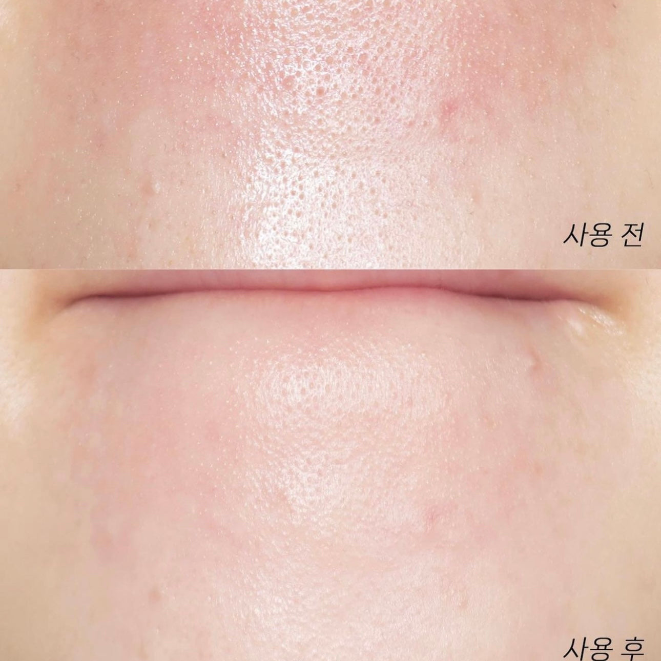 Hello Kitty x Ilso 限量特別版💖黑頭粉刺必試款🧹| Ilso溶解皮脂收毛孔導出液套裝 Ilso Super Melting Sebum Softener🦋