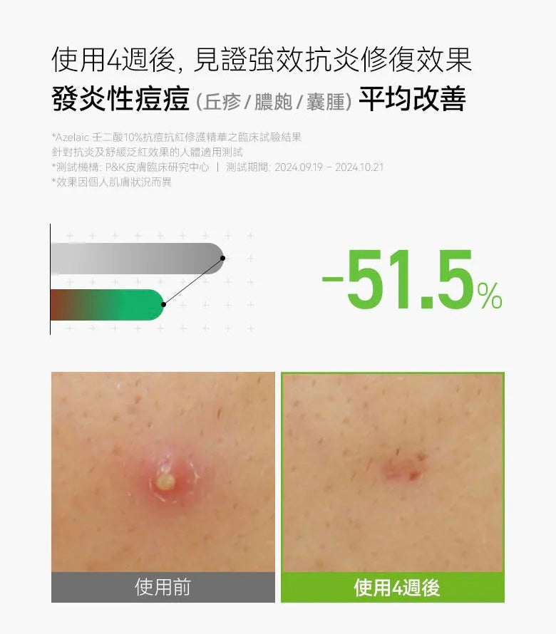 超多客人搵佢🔥告別煩人粉刺、紅疹、痘印⭐️Anua Azelaic壬二酸10%抗痘抗紅修護精華💚 Anua Azelaic Acid 10 Hyaluron Redness Soothing Serum