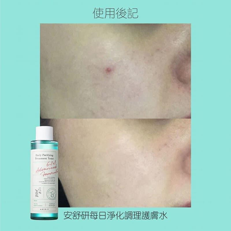 AXIS-Y 淨化消炎去痘調理爽膚水 200ml | 去角質 收毛孔 抑出油💖